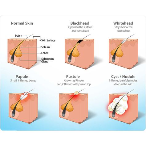 It is step 2 in ITB's successful three-step system for treating acne for dry, sensitive, and acne rosacea skin. Acne/Rosacea Amino Acid has effective bacterial control against P. acnes and other acne bacteria. It has concentrations of Salicylic Acid at 0.5% and Glycolic Acid at 1%. Its ability to keep follicles clear and its anti-inflammatory benefits also make it an essential product for rosacea and acne rosacea. Niacinamide and Curcumin have been added to boost the effectiveness and speed of c Painful Pimple, Cystic Acne Remedies, Skin Anatomy, Forehead Acne, Skin Facts, Types Of Acne, Acne Control, Homemade Beauty Tips, Benzoyl Peroxide