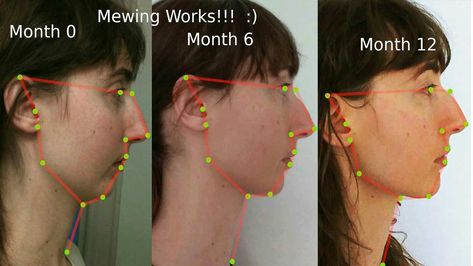 What Is Mewing and Does it Work? Doctor Mike, Jaw Exercises, Jawline Exercise, Chiseled Jawline, Facial Bones, Dr Mike, Face Change, Face Exercises, Facial Exercises