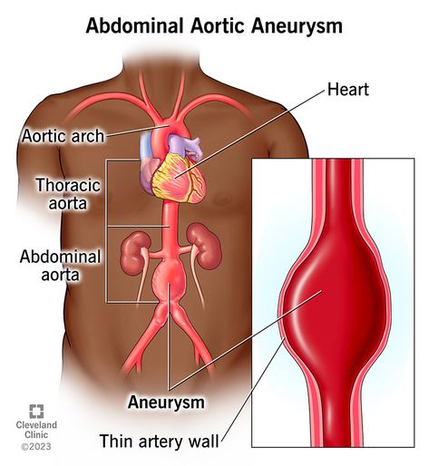 Abdominal Aorta, Fast Heartbeat, Genetic Diseases, Lower Extremity, Ct Scan, Cleveland Clinic, Abdominal Pain, Health Risks, Blood Vessels