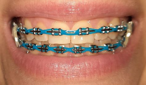 Blue Power Chain Braces, Black Braces Power Chain, Power Chain Braces Colors, Black Power Chain Braces, Braces Power Chain, Chain Braces, Power Chains, Power Chain Braces, Braces Journey