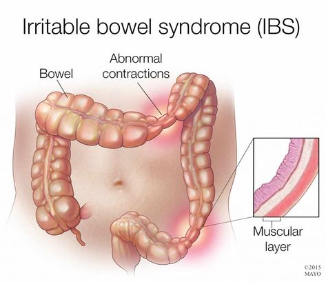 Inflammatory Bowel Syndrome, Irritable Bowel Disease, Probiotic Skin Care, Gastrointestinal Disease, Irritable Bowel, Mayo Clinic, Abdominal Pain, Acid Reflux, Natural Treatments