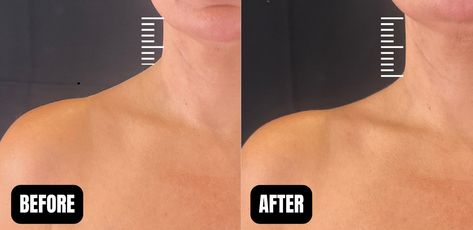 Trap BOTOX aka TrapTox in Santa Rosa and Healdsburg Slimmer Neck, Laser Hair Removal Face, Botox Results, Face Plastic Surgery, Nose Surgery Rhinoplasty, Mommy Makeover Surgery, Botox Before And After, Plastic Surgery Photos, Aesthetic Nurse