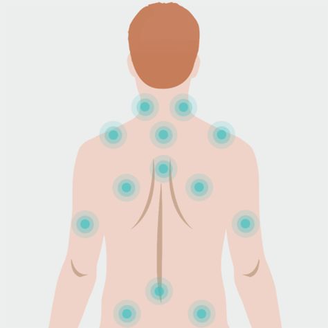 Muscle Knots In Back, Knots In Back, Forward Head Posture Exercises, Remedial Massage, Neck And Shoulder Muscles, Magnet Therapy, Muscle Knots, Forward Head Posture, Posture Exercises