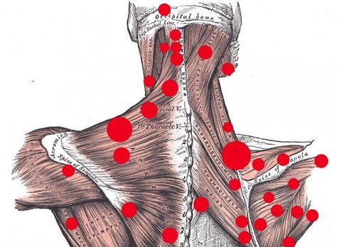 Massage Therapy: Do Trigger Points Exist? Punkty Spustowe, Wellness Clinic, Trigger Points, Tai Chi, Useful Life Hacks, Massage Therapy, Body Health, Healthy Tips, Yoga Poses