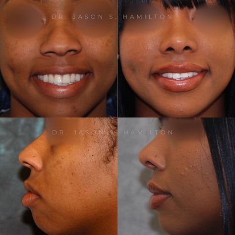 African American Rhinoplasty by Dr. Jason S. Hamilton. 2-year postoperative result. Looking amazing! Rhinoplasty Nose Jobs Asian, Ethnic Rhinoplasty African Americans, Droopy Tip Nose Rhinoplasty, Ethnic Rhinoplasty, Thick Skin Bulbous Tip Rhinoplasty, Rhinoplasty Droopy Tip, Rhinoplasty Before And After, Before After Photo, Nose Job