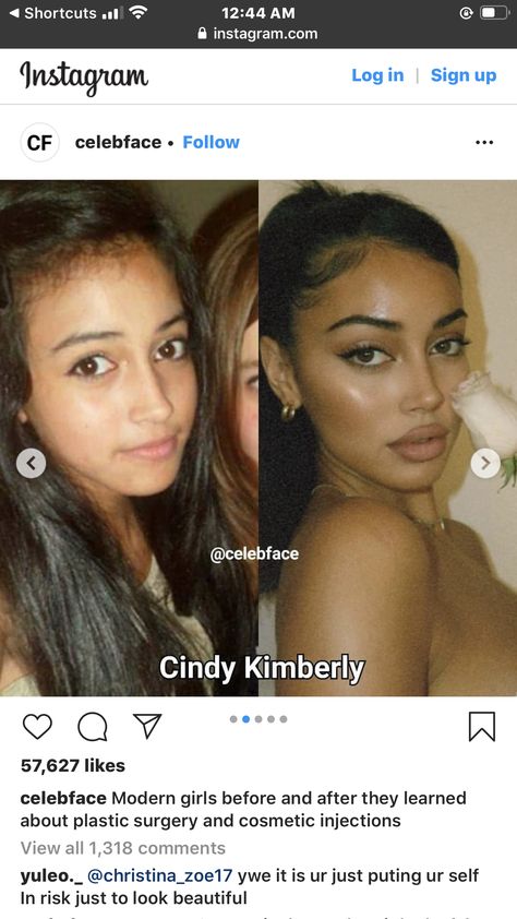 High Vs Low Nose Bridge, Cindy Kimberly Before And After Surgery, Alarplasty Before After, Nose Filler Before After Non Surgical, Nose Botox Before And After, Nose Filler Before After, Under Eye Filler Before And After, Long Philtrum, Glow Up Before And After