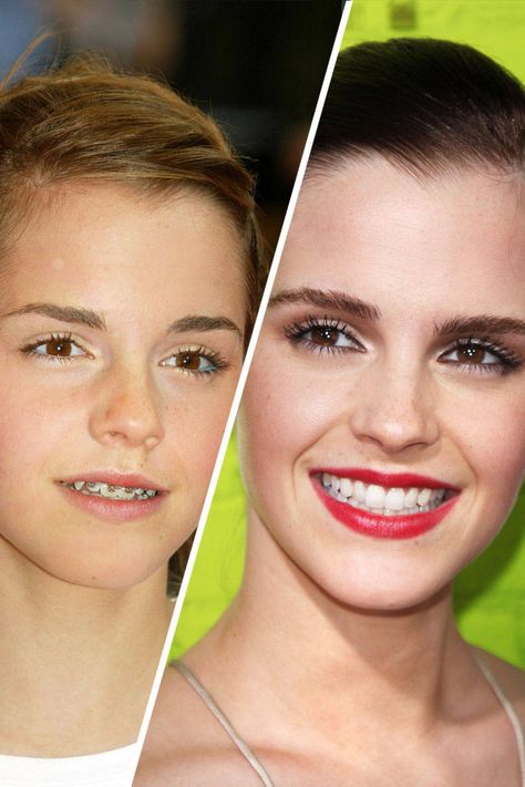 Emma Watson  Emma Watson “I had terrible skin at one point,” Emma Watson said last fall, “and had to wear braces at another, and my weight h... Celebrities With Braces, Braces Humor, Celebrity Teeth, Braces Before And After, Dentistry Clinic, After Braces, Pretty Lips, Celebrity Smiles, Hair Implants