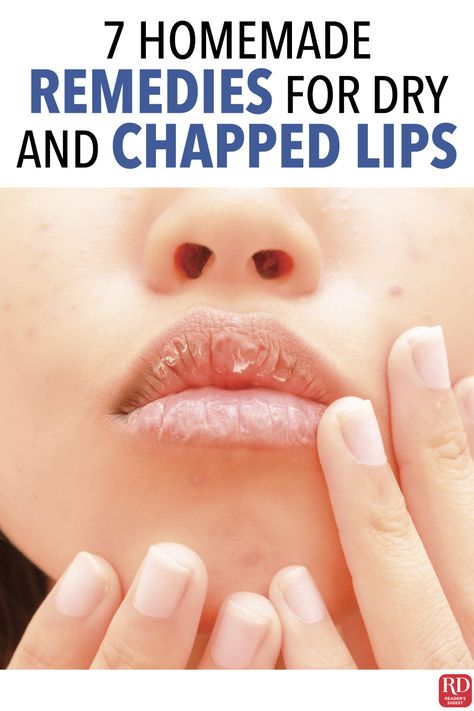 How To Heal Chapped Lips Fast, Chapped Lips Remedy Severe, Remedy For Chapped Lips, Lip Remedies, Dry Lips Remedy, Chapped Lips Remedy, Sore Lips, Lips Care, Girl Hacks