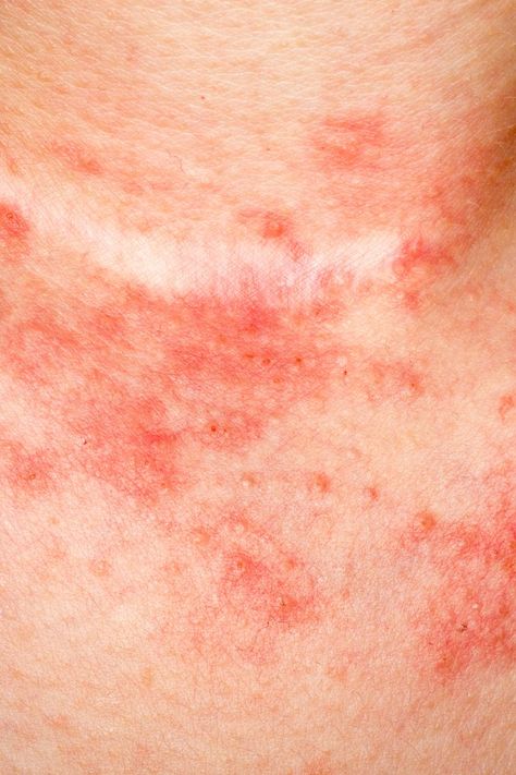 Dry air and temperature swings can be hard on your skin, especially when you have atopic dermatitis. Try these tips to minimize irritation and itch this winter. Warts On Hands, Calamine Lotion, Face Scrub Homemade, Peeling Skin, Skin Diseases, Skin Irritation, Itchy Skin, Skin Conditions, Irritated Skin