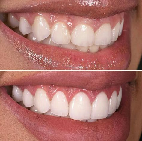 Whiten Teeth Fast, I Healed, Whiten Teeth, Porcelain Veneers, Before Going To Bed, Receding Gums, Tooth Decay, Cavities