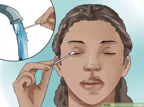 Image titled Get Rid of a Stye Step 1 Sty In Eye Remedies, Get Rid Of Stye, Stye Remedy, Eye Stye Remedies, Swollen Eyelid, Simple Skincare, Skin Care Regimen, Beautiful Skin, Good Skin