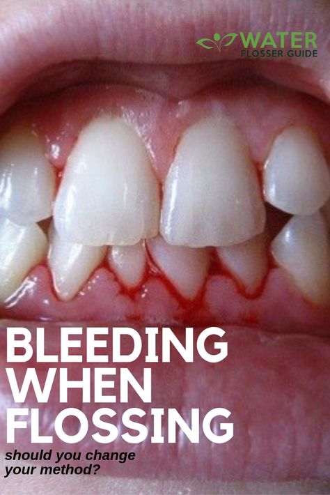 Flossing is one of the two main pillars of your daily oral hygiene regimen. However, more often than not most people encounter a bit of bleeding when flossing. Now, is this a normal thing to expect? Or should it really be looked at in more detail determine exactly why this might be happening? Keep reading for a thorough explanation as to why this is labeled a ‘normal thing’. #flossing #waterflosser #waterpik #comparisons #heartdisease #oralhealth #dentalcare #waterpikcomparisons Water Flosser Benefits, Teeth Hygiene, Flossing Teeth, Gum Inflammation, Calorie Workout, Dental Cavities, Dental Humor, Water Flosser, Periodontal Disease