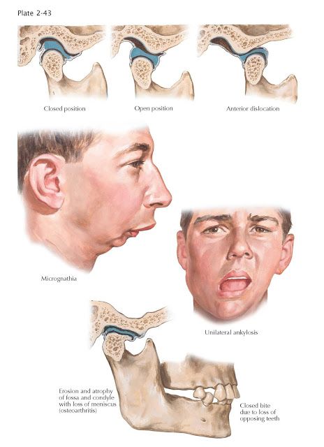 Abnormalities of Temporomandibular Joint   The glenoid fossa of the temporal bone and the mandibular condyle constitute a compound, diart... Temporal Bone, Dental Photos, Dental World, Kidney Pain, Remedies For Tooth Ache, Nursing School Essential, Dental Hygiene School, Human Body Anatomy, Dental Art