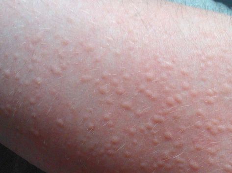 Hives. An allergic reaction to something; itchy bumps caused by histamine production. Allergic Reaction Rash, Types Of Skin Rashes, Low Histamine Diet, Liver Diet, Stomach Cramps, Medication Management, Gluten Sensitivity, Excessive Sweating, Partner Workout