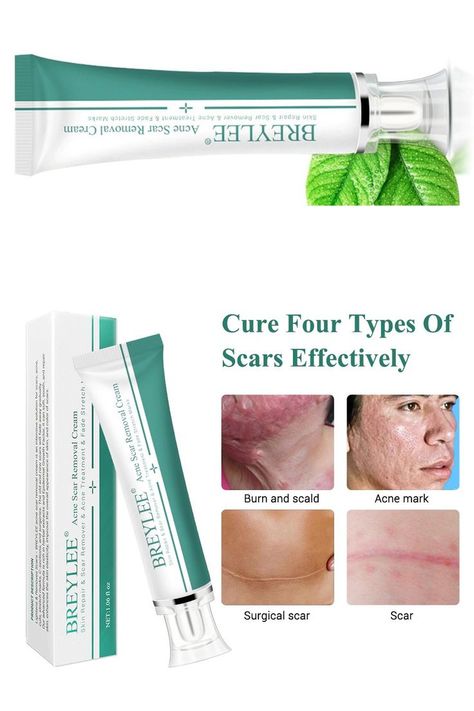 Face Pimples, Acne Scar Removal Cream, Hypertrophic Scars, Scar Removal Cream, Scar Remover, Scar Cream, Pimple Scars, Pimples On Face, Acne Scar