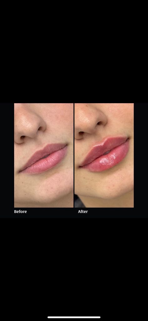 Lip Fuller Shapes, Lips Filer Shape, Lip Filler Heavy Upper Lip, Lip Fillers Heart Shape, Heart Shape Lips Fillers, Lip Filler 2ml, Lip Filler Shape Ideas Pouty, Small Lips Lip Filler, Lip Filler Shape Ideas 1ml