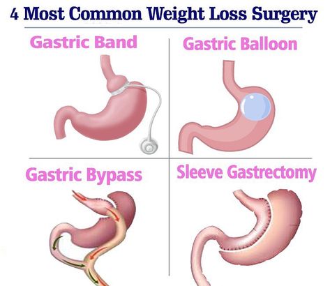 Tukey Weight Loss on Instagram: “Different Types Of Weight Loss Surgery, Main types of weight loss surgery: ✔️Gastric Band ✔️Gastric Balloon ✔️Gastric Bypass ✔️Sleeve…” Gastric Bypass Sleeve, Gastric Balloon, Gastric Band, Sleeve Gastrectomy, Gastric Bypass, Different Types, Surgery, Balloons, Band