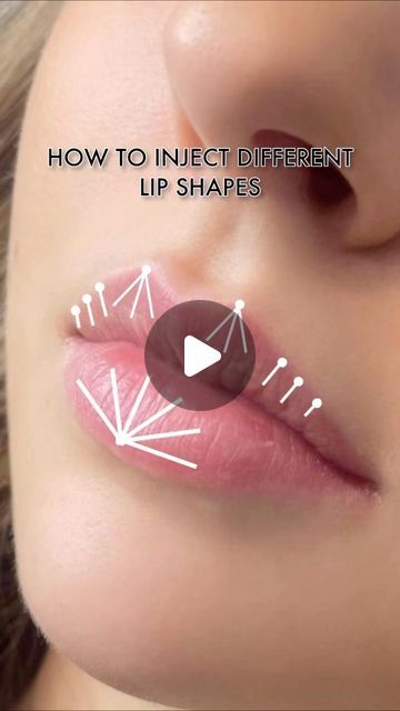 Botox For Headaches, Different Lip Shapes, 1ml Lip Filler, Botox Injection Sites, Juvederm Lips, Esthetician Inspiration, Heart Shaped Lips, Botox Lips, Botox Cosmetic