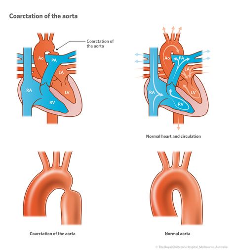 Congenital Heart Defect Nursing, Pediatric Cardiac Nursing Congenital Heart Defect, Coarctation Of The Aorta, Coronary Angiography Views, Coronary Bypass Surgery Heart, Pulmonary Artery Catheter, Congenital Heart, Heart Defect, Congenital Heart Defect