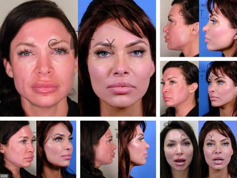 Lip Lift Before and After | New York Plastic Surgeon Dr. Linkov Lip Lift Before And After, Lip Lift Surgery, Lip Flip, Lip Surgery, Lip Lift, Facial Plastic, Surgery Recovery, Scar Tissue, After Photos