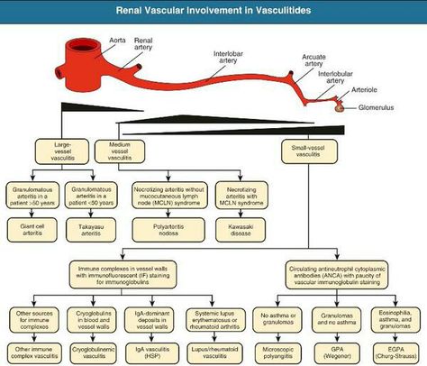 Classification of vasculitis  General symptoms: Fever Skin: Palpable purpura, livedo reticularis. Muscles& joints: Myalgia or myositis, arthralgia or arthritis.Nervoussystem:Mononeuritis,multiplex,headache,  stroke, tinnitus, reduced visual acuity, acute visual loss.Heart and arteries: Myocardial infarction, hypertension, gangrene.Respiratory tract: Nose bleeds, bloody cough.GI tract: Abdominal pain, bloody stool, perforations.Kidneys: Glomerulonephritis. Livedo Reticularis, Ear Problems, Nose Bleeds, Sick Remedies, Inner Ear, Medical Facts, Gi Tract, Cardiovascular System, Hearing Loss