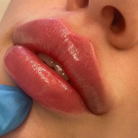 Lips Inspiration, Botox Lips, Facial Fillers, Facial Aesthetics, Lip Filler, Lip Enhancement, Lip Shapes, Lip Injections, Perfect Lips