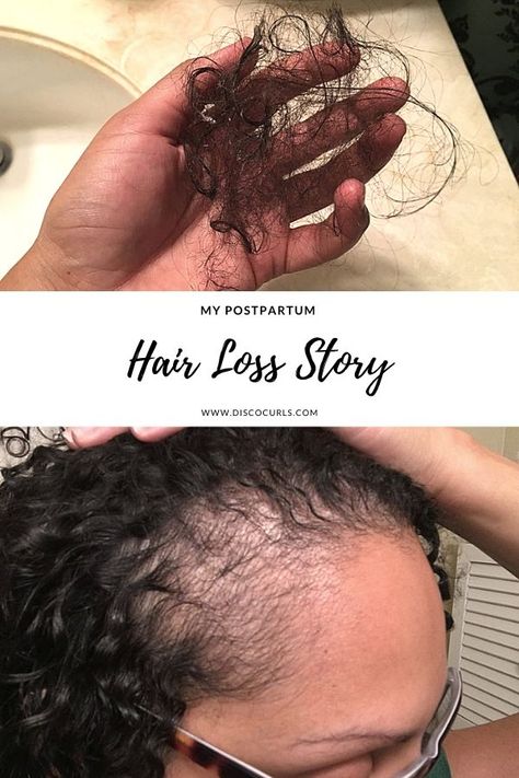 My Postpartum Hair Loss & Shedding Story - DiscoCurls Postpartum Hair, Post Partum Haircut, Post Partum Hairloss Hairstyles, Postpartum Hair Shedding, Postpartum Haircut, Regrow Hair Women, Postpartum Hair Regrowth, Pregnant After Loss, Ways To Grow Hair