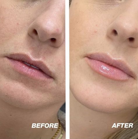 Kendall Jenner Lip Fillers, Small Lip Injections, Lip Filler Timeline, Lip Fillers Natural Look, Volbella Lips Before And After, Small Lip Fillers Before And After, Lip Filler Inspiration 0.5ml, Minimal Lip Fillers, 0.5 Lip Filler