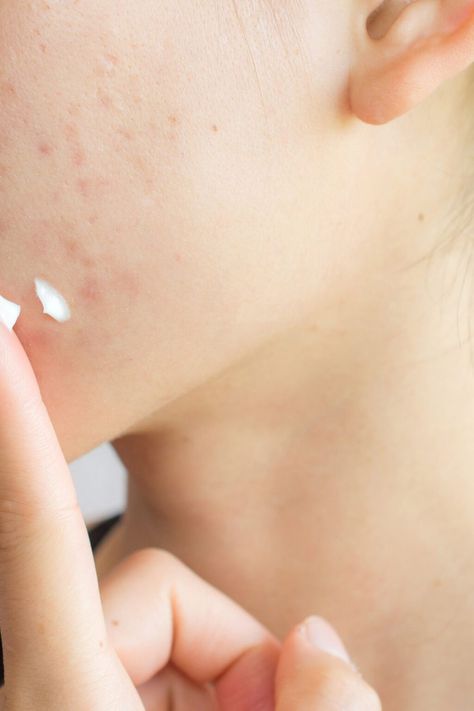 Discover TikTok's latest acne hack: could Head and Shoulders treat your acne? Experts explore dandruff shampoo for acne. Acne Hacks, How To Wash Makeup Brushes, Pain Relief Cream, Acne Causes, Moisturizing Toner, Acne Solutions, Head & Shoulders, Daily Skin Care Routine, Skin Care Acne