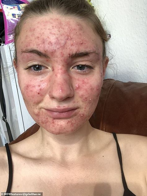 Woman, 20, who had 'never had a single pimple' until she went on the Pill claims it caused her face to break out in 'painful' cystic acne so severe that it affected her sight Skincare Jerawat, Nodular Acne, Closed Comedones, Blackhead Scrub, Pimple Extractor, Brown Spots Removal, Severe Acne, Types Of Acne, How To Get Rid Of Pimples