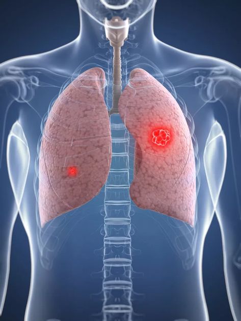 Pleural Effusion, Lungs, Illustration Artwork, Cavities, Lava Lamp