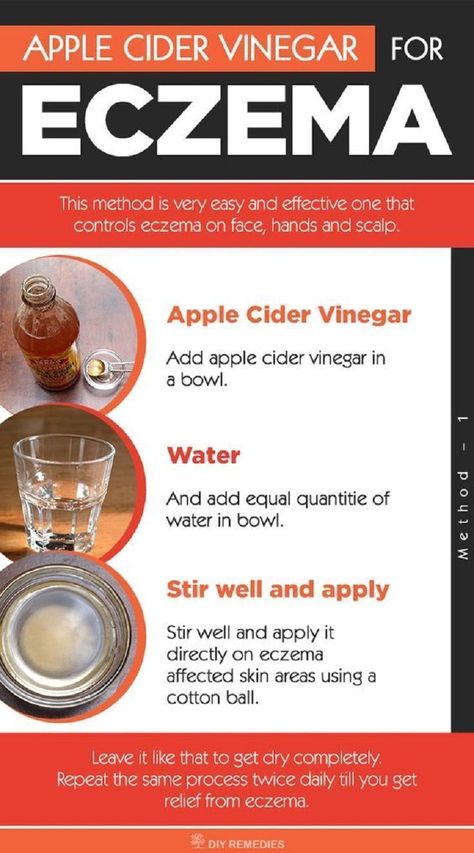 Use Apple Cider Vinegar To Treat Eczema, It�s Unbelievably Effective Diy Remedies, Cider Vinegar, Apple Cider Vinegar, Apple Cider, Home Remedies, Vinegar, Cider, Just In Case, How To Use