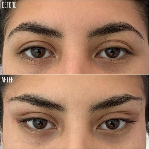 Discover Aesthetics on Instagram: “NON SURGICAL BROW LIFT with PDO threads! 👁 Follow @discover.aesthetics for more!⠀⠀⠀⠀⠀ -⠀⠀⠀⠀⠀ The #1 Destination to discover the Wide Array…” Eye Lift Surgery, Botox Brow Lift, Pdo Threads, Botox Lips, Face Surgery, Eyebrow Lift, Beauty Procedures, Thread Lift, Facial Fillers