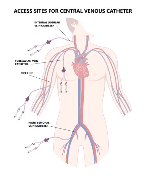 CEUfast.com - graphic of picc line access sites Central Line Catheter, Central Venous Pressure, Central Venous Catheter, Arm Veins, Picc Line, Central Line, White Blood Cells, Nurse Practitioner, Ultrasound