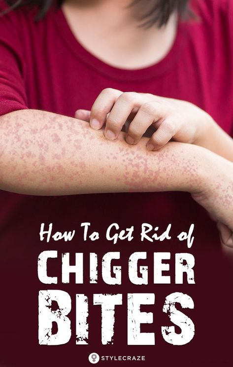 Chiggers Get Rid Of Bites, How To Get Rid Of Chiggers, Chigger Bite Remedy, Red Bug Bites, Bug Bite Relief, Diy Facials, Bite Relief, Bug Bite, Tick Bite