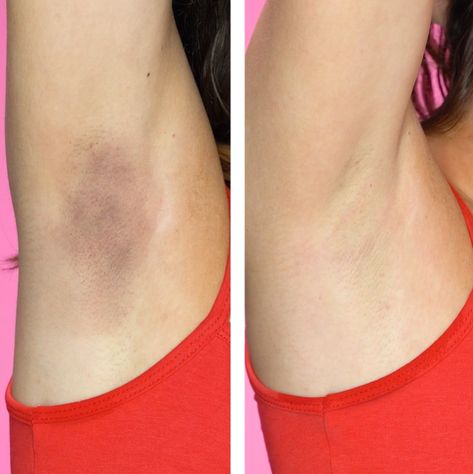 Armpit whitening beauty hack Armpit Whitening, Unexpected Beauty, Dark Armpits, Underarm Odor, Underarm Hair Removal, Dark Underarms, Skin Natural Remedies, Home Beauty Tips, Body Hair Removal