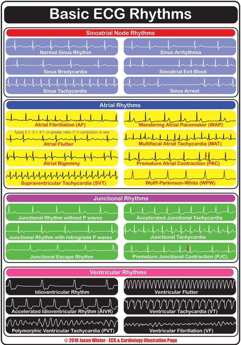 Diagonosis ok ecg Cardiology Nursing, Paramedic School, Nursing Mnemonics, Cardiac Nursing, Pharmacology Nursing, Nursing School Survival, Critical Care Nursing, Nursing School Studying, Nursing School Tips