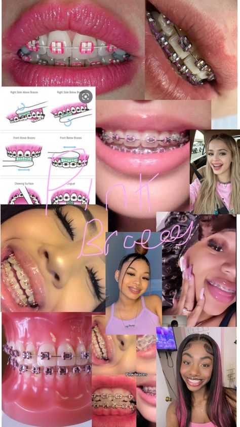 Pink Braces, Braces Food, Cute Braces Colors, Pretty Teeth, Braces Tips, Getting Braces, Cute Braces, Diamond Teeth, Clear Braces