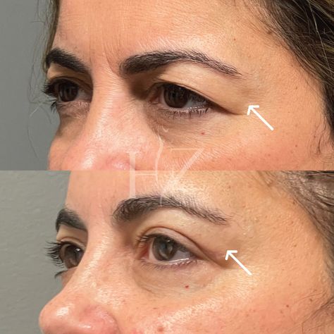 Belfaroplasty Eyes, Blethoplasty Before And After, Eyelid Lift Before After, Upper Eye Lid Surgery Before And After, Upper Eyelid Lift Surgery, Eyelid Lift Surgery Before After, Upper Blephoraplasty Before And After, Blephoraplasty Before And After, Lower Face Lift