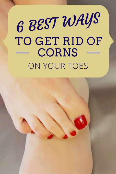 Get Rid Of Corns On Feet Fast, Remove Corns On Feet Remedies, Foot Corn Removal Remedies, How To Get Rid Of Corns On Toes, Corn Removal On Toes, Get Rid Of Corns, Corn Removal, Foot Soaks, Diy Pedicure