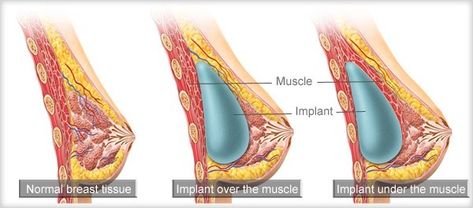 Breast implants can be placed in three distinct locations within the breast during a breast augmentation surgery. To better understand why your plastic surgeon might recommend one placement over another, read through our latest blog post. Exocrine Gland, Human Tissue, Pectoral Muscles, Mammary Gland, Breast Reconstruction, Human Body Parts, Breast Surgery, Adipose Tissue, Breast Lift