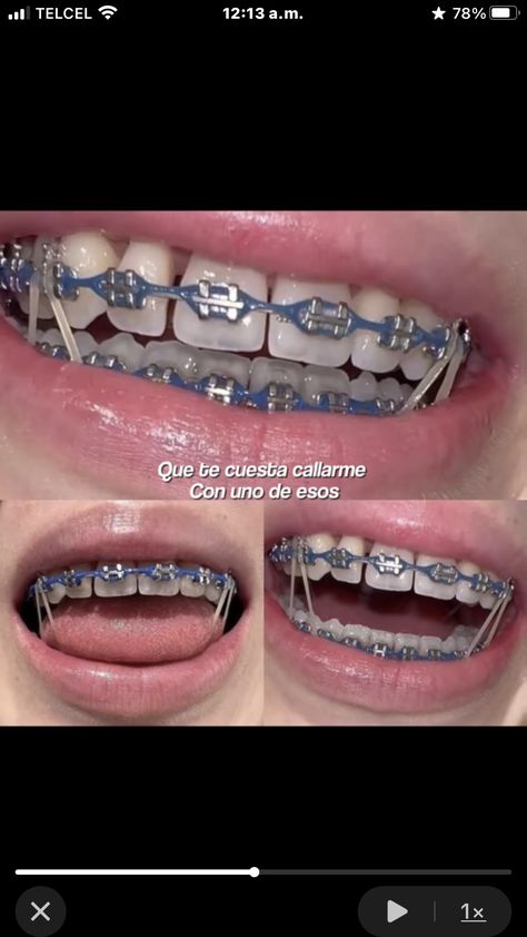 Lavender Braces, Wyatt Core, Dark Blue Braces, Brace Colors, Braces Colours, Braces Blue, Pink Braces, Braces Food, Sparkly Phone Cases