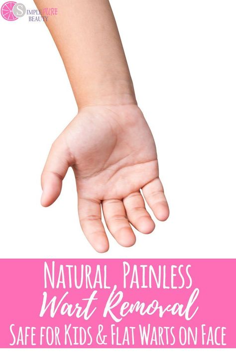 Wondering how to get rid of warts? Don't fret. There is a perfectly natural way to aid with that. Even though there are various types of warts out there, you can still use this natural and homemade painless remedy. Safe to even use on kids as well! Don't let harsh chemicals come in contact with your plantar wart when you can use this instead. Safe to use on your foot, hands, face or other external areas of the body. #wartremoval #plantar #beauty #health #essentialoils Flat Warts, Types Of Warts, Plantar Warts, Warts Removal, Warts On Hands, Warts On Face, Home Remedies For Warts, Warts Remedy, Remove Skin Tags Naturally