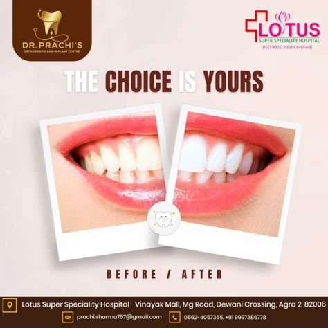 Transform your smile! Check out the incredible before and after results. Book your appointment today! 😁🦷   Contact Us @ 099973 86778, 0562 405 7365 -------  #SmileTransformation #BeforeAndAfter #DentistAppointment #HealthyTeeth #DentalCare #BookNow Before And After Social Media Design, Before And After Creative Ads, Dental Before And After, Dental Advertisement, Dental Ads, Clinic Art, Digital Marketing Infographics, Dental Social Media, Dental Posts