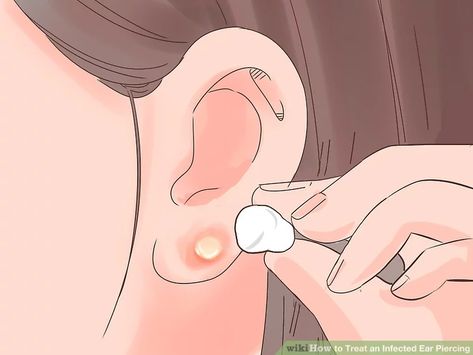 How to Treat an Infected Ear Piercing: 14 Steps (with Pictures) Ear Piercing At Home, Piercing At Home, Infected Ear Piercing, Ear Piercing Care, Zit Remedy, Piercing Bump, New Ear Piercing, Getting Your Ears Pierced, Ear Peircings