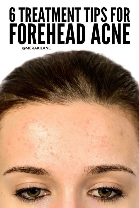 You have to get to the root cause of your acne to make real progress in clearing it. Here's what your breakouts mean and how to treat them. What Acne Means On Different Parts Of Your Face, Forehead Acne Cause, Forehead Breakout, Cheek Acne, Head Acne, Acne Cleaning, Dilated Pores, Forehead Acne, Clean Blackheads