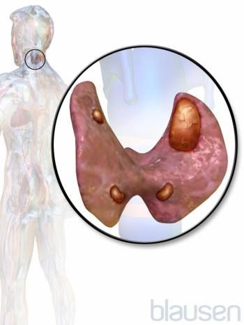 Hypercalcemia (High Level of Calcium in the Blood) - Hormonal and Metabolic Disorders - Merck Manuals Consumer Version Parathyroid Disease, Multiple Endocrine Neoplasia, High Calcium, Metabolic Disorders, Thyroid Health, Health Guide, Hormone Health, Medical Knowledge, Blood Test