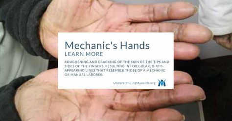 Mechanic's Hands and Myositis Mechanics Hands, Autoimmune Disease, Disease