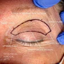 Skin Marking in Cosmetic Upper Blepharoplasty Upper Blephoraplasty, Upper Blephoraplasty Before And After, Skin Marks, Upper Eyelid, Dermatology, Relaxed Style, Surgery, The First, Skin