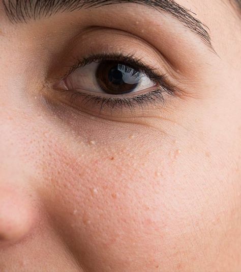 How To Get Rid Of Milia White Pimples On Face, White Bumps On Face, Eminence Organic Skin Care, Pimples On Face, Chemical Peel, Dermatology, Skin Tightening, Skin Conditions, Eye Care